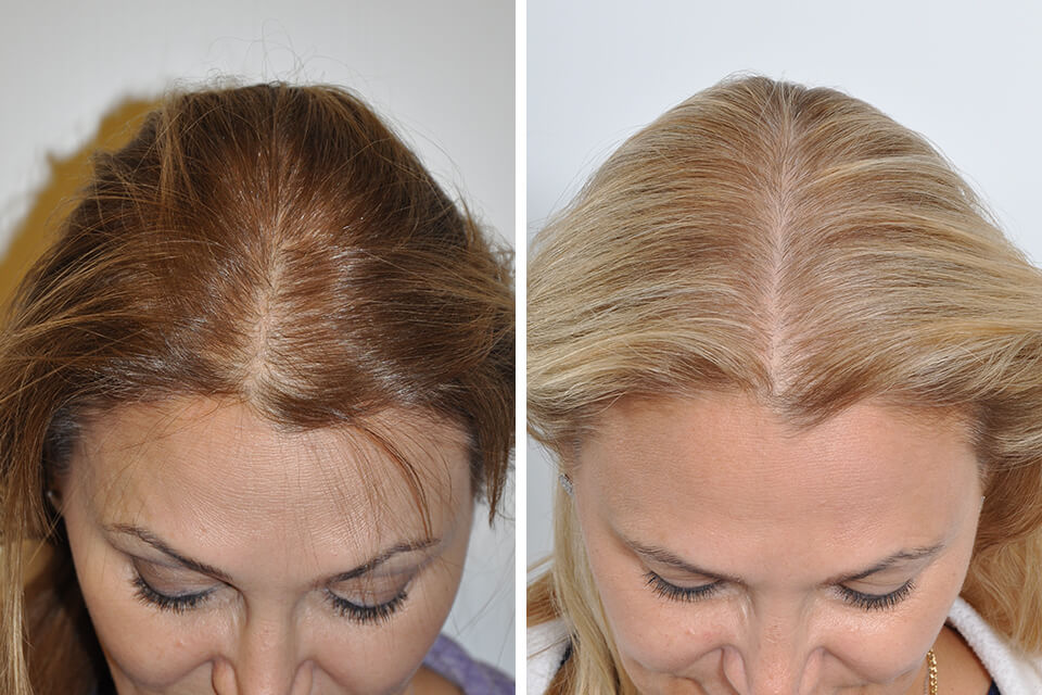 What Steps can Women take to Begin their Hair Restoration Journey?